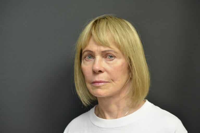 After Image: Naturale in office deep plane face-neck lift. In office under local anesthesia and oral sedation - front