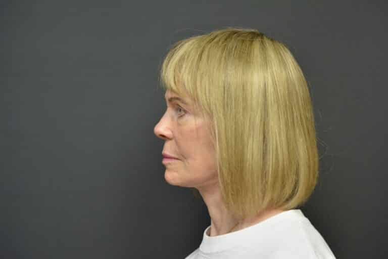 After Image: Naturale in office deep plane face-neck lift. In office under local anesthesia and oral sedation - front