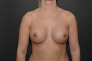 After Image: Breast augmentation with silicone implants