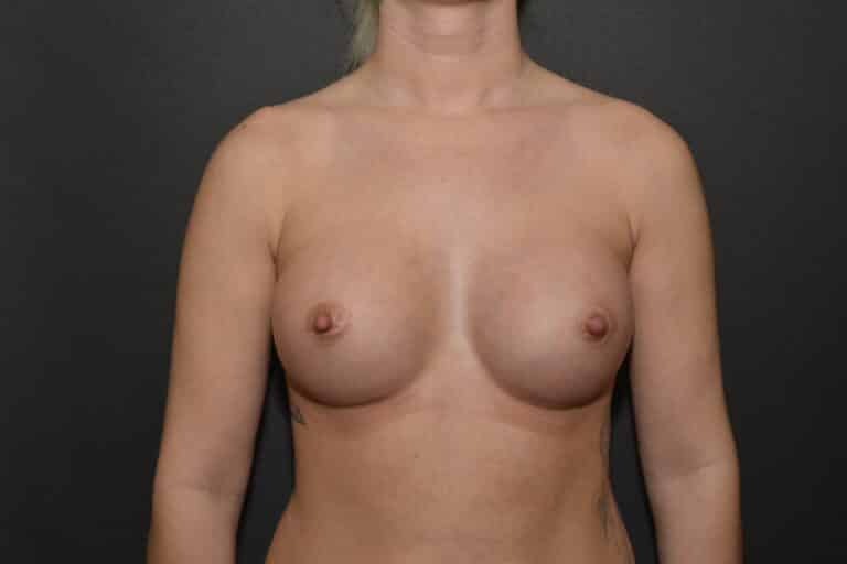 After Image: Breast augmentation with silicone implants - front