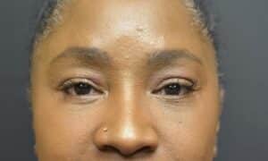 After Image: Lower blepharoplasty (only)