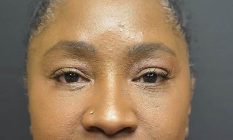 After Image: Lower blepharoplasty (only) - front