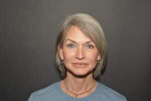 After Image: Naturale face neck lift Deep plane and cervical platsymoplasty with Lip Lift under local anesthesia and oral sedation in office