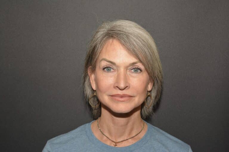 After Image: Naturale face neck lift Deep plane and cervical platsymoplasty with Lip Lift under local anesthesia and oral sedation in office - front