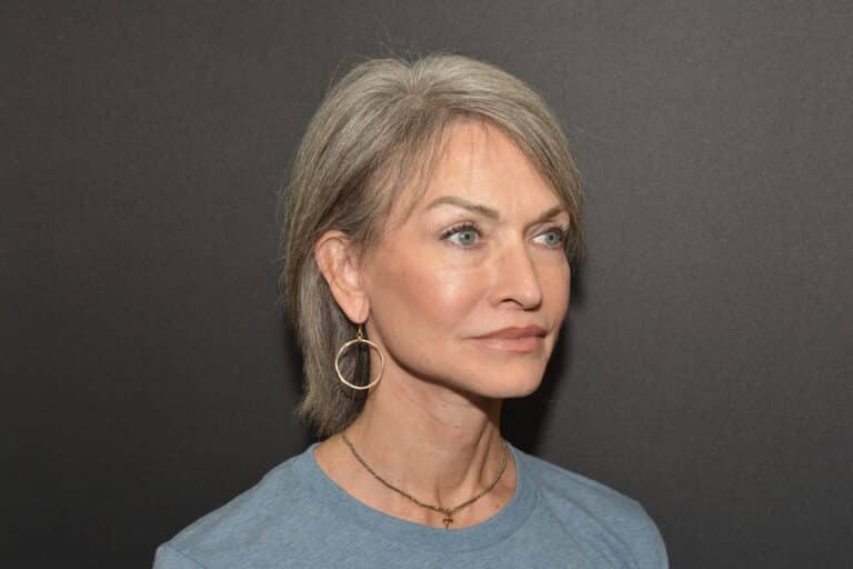 After Image: Naturale face neck lift Deep plane and cervical platsymoplasty with Lip Lift under local anesthesia and oral sedation in office - front