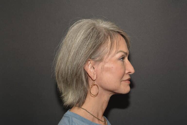 After Image: Naturale face neck lift Deep plane and cervical platsymoplasty with Lip Lift under local anesthesia and oral sedation in office - front