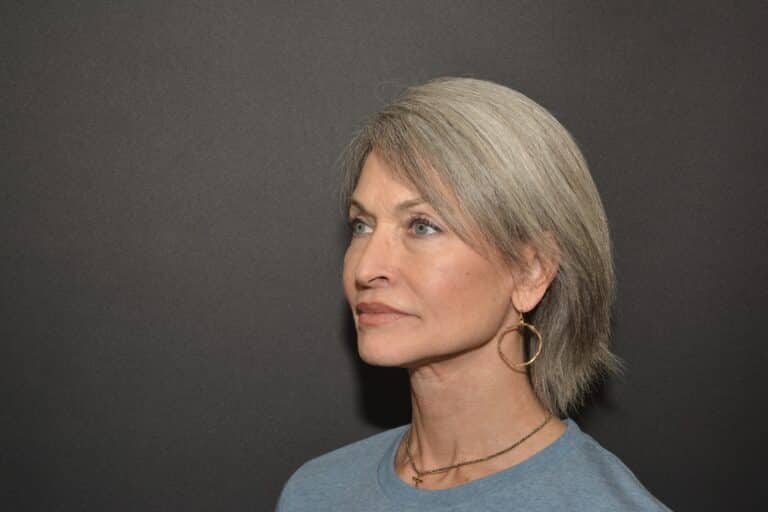 After Image: Naturale face neck lift Deep plane and cervical platsymoplasty with Lip Lift under local anesthesia and oral sedation in office - front