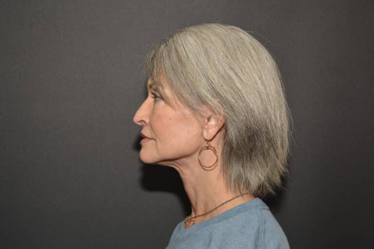 After Image: Naturale face neck lift Deep plane and cervical platsymoplasty with Lip Lift under local anesthesia and oral sedation in office - front