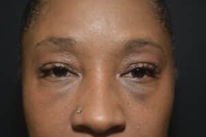 Before Image: Lower blepharoplasty (only)