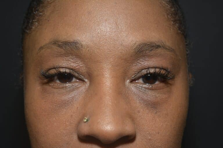 Before Image: Lower blepharoplasty (only) - front
