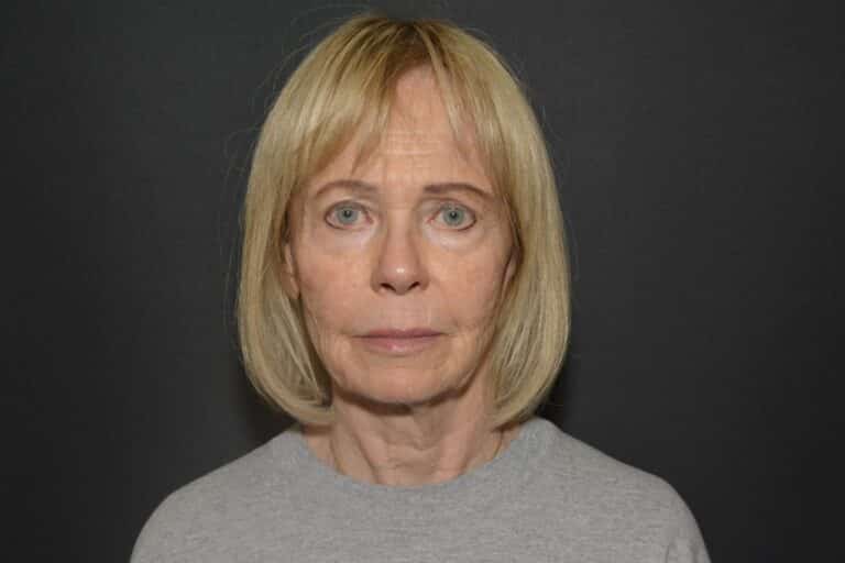 Before Image: Naturale in office deep plane face-neck lift. In office under local anesthesia and oral sedation - front