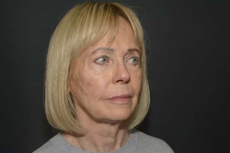 Before Image: Naturale in office deep plane face-neck lift. In office under local anesthesia and oral sedation - front
