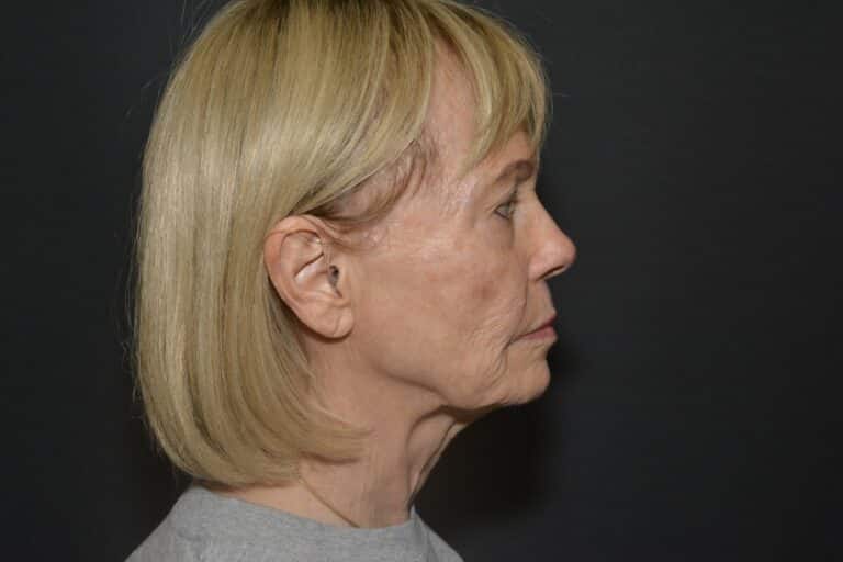 Before Image: Naturale in office deep plane face-neck lift. In office under local anesthesia and oral sedation - front