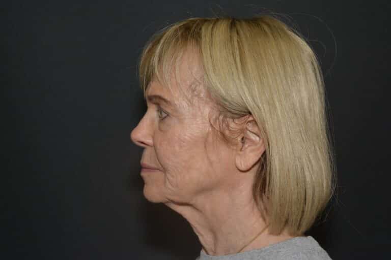 Before Image: Naturale in office deep plane face-neck lift. In office under local anesthesia and oral sedation - front