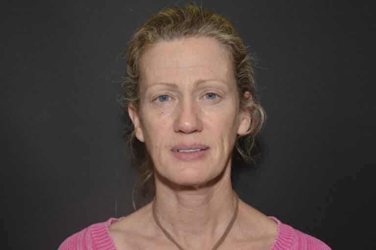 Before Image: Naturale in office deep plane face-neck lift. In office under local anesthesia and oral sedation - front