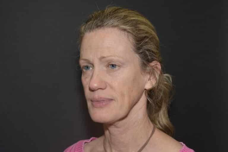 Before Image: Naturale in office deep plane face-neck lift. In office under local anesthesia and oral sedation - front