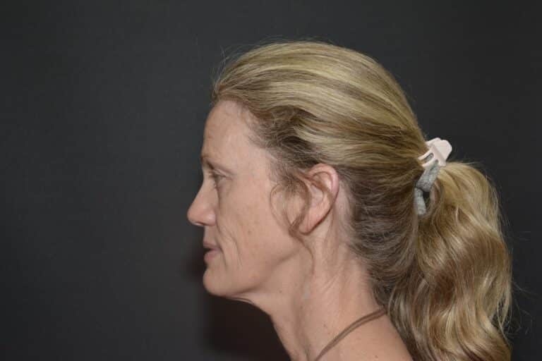 Before Image: Naturale in office deep plane face-neck lift. In office under local anesthesia and oral sedation - front
