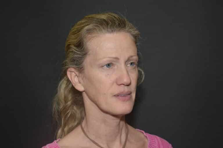 Before Image: Naturale in office deep plane face-neck lift. In office under local anesthesia and oral sedation - front