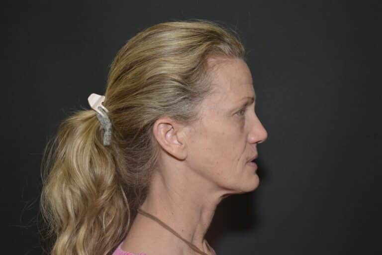 Before Image: Naturale in office deep plane face-neck lift. In office under local anesthesia and oral sedation - front