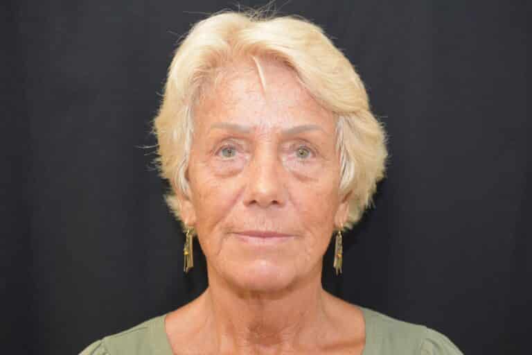 Before Image: Naturale in office deep plane face-neck lift. In office under local anesthesia and oral sedation - front