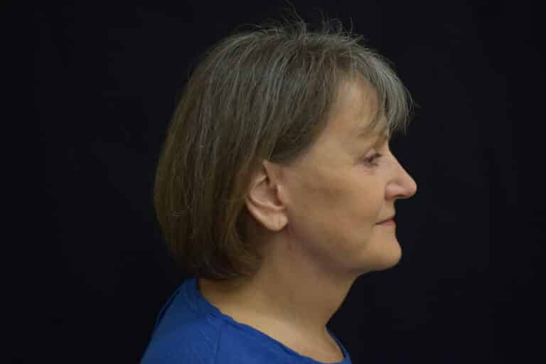 After Image: Naturale in office deep plane face-neck lift. In office under local anesthesia and oral sedation - front