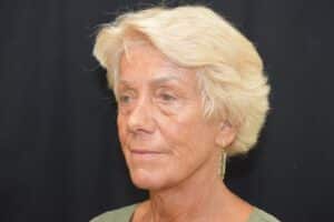 Before Image: Naturale in office deep plane face-neck lift. In office under local anesthesia and oral sedation