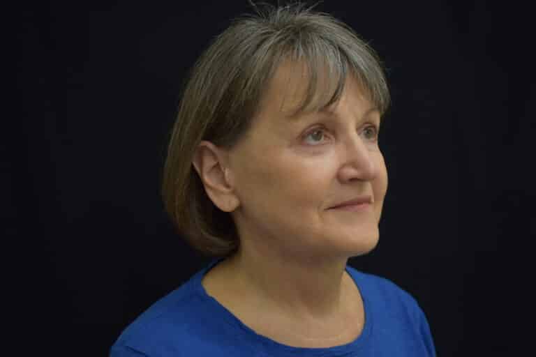 After Image: Naturale in office deep plane face-neck lift. In office under local anesthesia and oral sedation - front