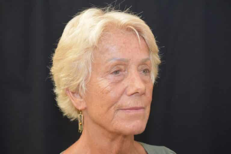 Before Image: Naturale in office deep plane face-neck lift. In office under local anesthesia and oral sedation - front