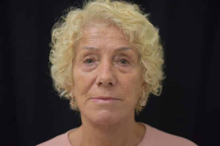 After Image: Naturale in office deep plane face-neck lift. In office under local anesthesia and oral sedation - front