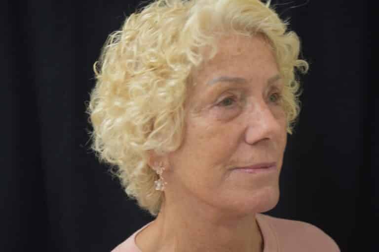 After Image: Naturale in office deep plane face-neck lift. In office under local anesthesia and oral sedation - front