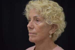 After Image: Naturale in office deep plane face-neck lift. In office under local anesthesia and oral sedation