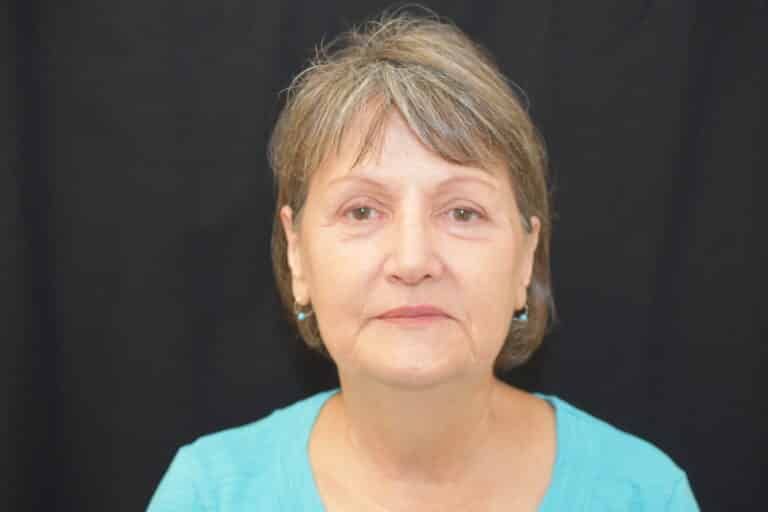 Before Image: Naturale in office deep plane face-neck lift. In office under local anesthesia and oral sedation - front