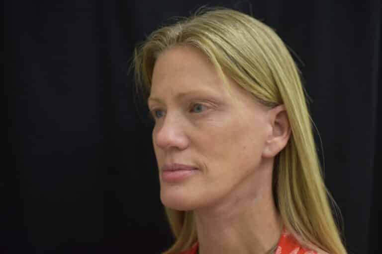 After Image: Naturale in office deep plane face-neck lift. In office under local anesthesia and oral sedation - front