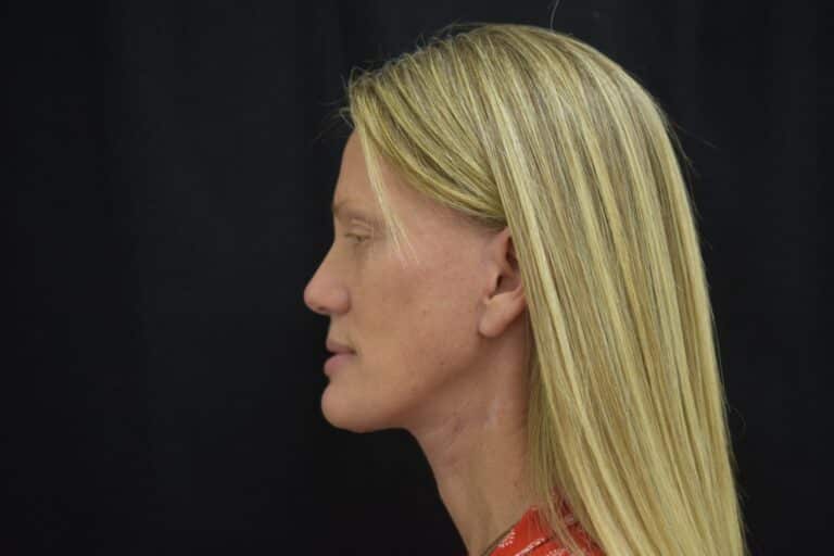 After Image: Naturale in office deep plane face-neck lift. In office under local anesthesia and oral sedation - front