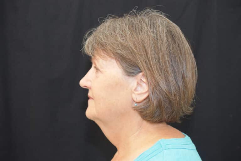 Before Image: Naturale in office deep plane face-neck lift. In office under local anesthesia and oral sedation - front