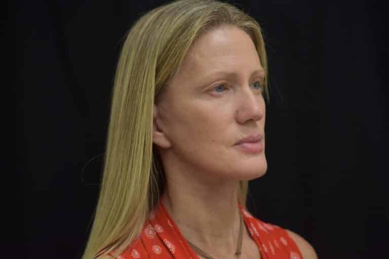 After Image: Naturale in office deep plane face-neck lift. In office under local anesthesia and oral sedation - front