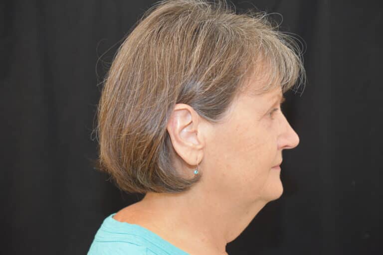 Before Image: Naturale in office deep plane face-neck lift. In office under local anesthesia and oral sedation - front