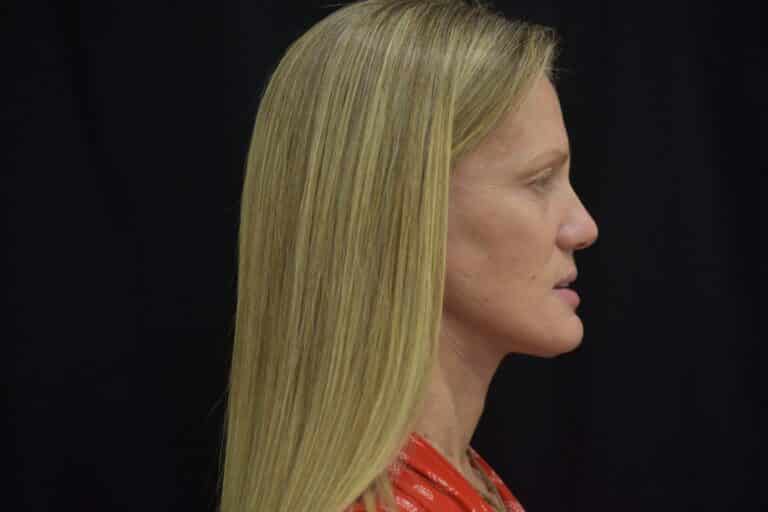 After Image: Naturale in office deep plane face-neck lift. In office under local anesthesia and oral sedation - front