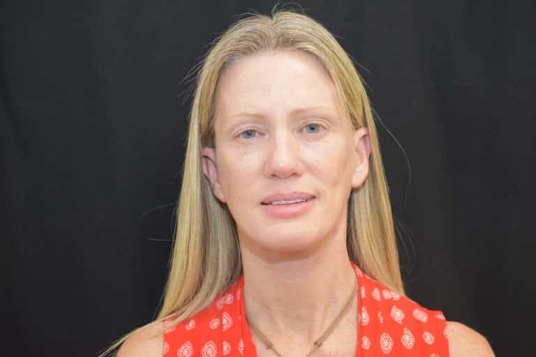 After Image: Naturale in office deep plane face-neck lift. In office under local anesthesia and oral sedation - front