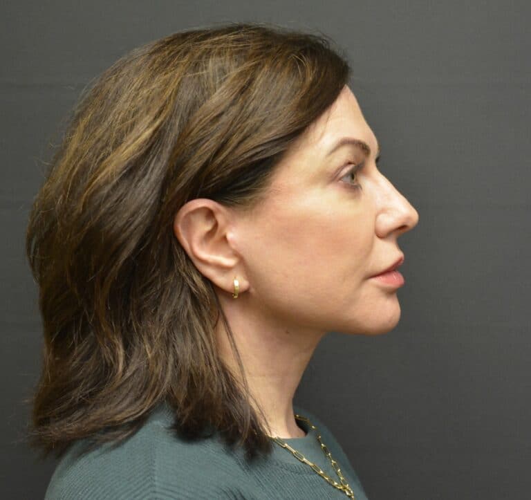 After Image: Naturale face-neck lift - 