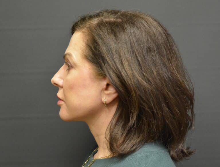After Image: Naturale face-neck lift - 