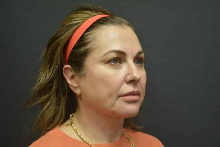 Before Image: Naturale face-neck lift - 