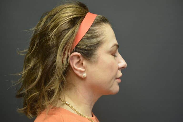 Before Image: Naturale face-neck lift - 