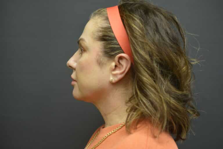 Before Image: Naturale face-neck lift - 