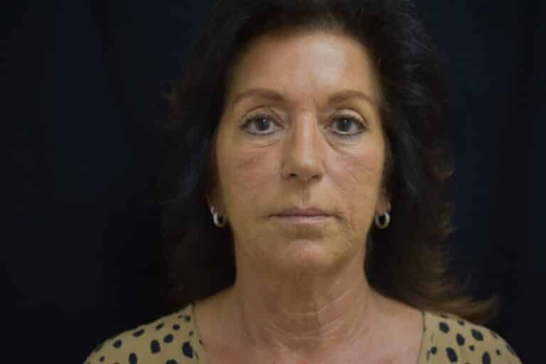 Before Image: Naturale face neck lift - 
