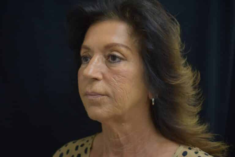 Before Image: Naturale face neck lift - 