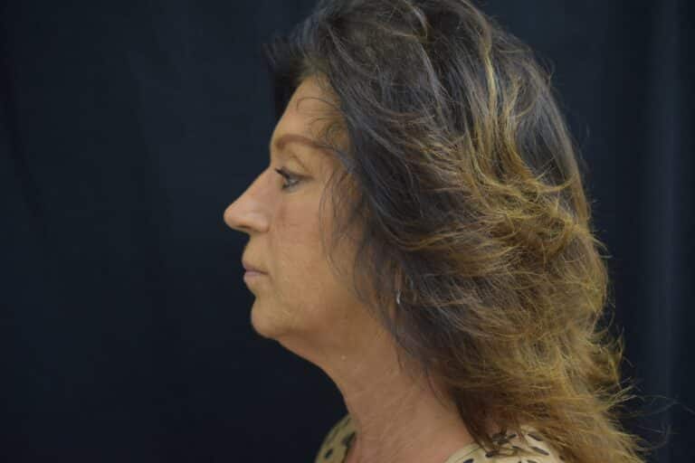Before Image: Naturale face neck lift - 
