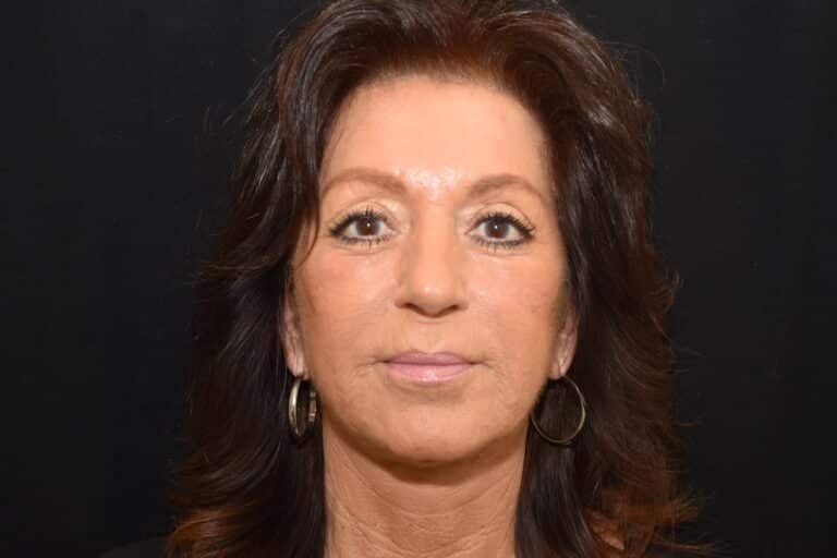 After Image: Naturale face neck lift - 