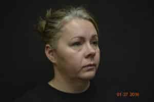 Before Image: Naturale face neck lift