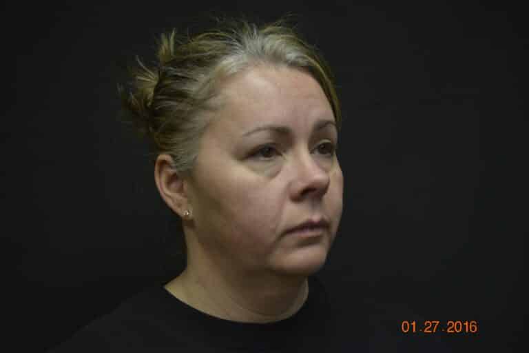 Before Image: Naturale face neck lift - front